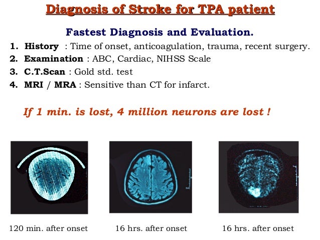 Image result for stroke diagnosis