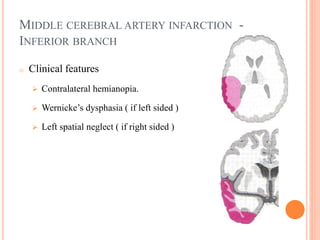 MIDDLE CEREBRAL ARTERY INFARCTION -
INFERIOR BRANCH
o Clinical features
 Contralateral hemianopia.
 Wernicke’s dysphasia ( if left sided )
 Left spatial neglect ( if right sided )
 
