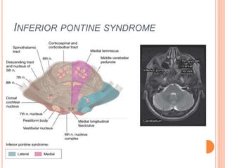 INFERIOR PONTINE SYNDROME
 