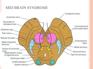 MID BRAIN SYNDROME
 