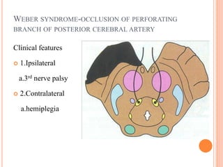 WEBER SYNDROME-OCCLUSION OF PERFORATING
BRANCH OF POSTERIOR CEREBRAL ARTERY
Clinical features
 1.Ipsilateral
a.3rd nerve palsy
 2.Contralateral
a.hemiplegia
 
