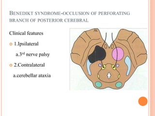 BENEDIKT SYNDROME-OCCLUSION OF PERFORATING
BRANCH OF POSTERIOR CEREBRAL
Clinical features
 1.Ipsilateral
a.3rd nerve palsy
 2.Contralateral
a.cerebellar ataxia
 