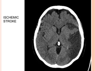 ISCHEMIC
STROKE
 