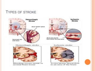 TYPES OF STROKE
 