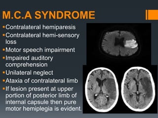M.C.A SYNDROME
Contralateral hemiparesis
Contralateral hemi-sensory
loss
Motor speech impairment
Impaired auditory
comprehension
Unilateral neglect
Ataxia of contralateral limb
If lesion present at upper
portion of posterior limb of
internal capsule then pure
motor hemiplegia is evident.
 
