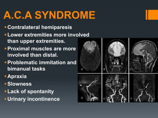 A.C.A SYNDROME
Contralateral hemiparesis
Lower extremities more involved
than upper extremities.
Proximal muscles are more
involved than distal.
Problematic immitation and
bimanual tasks
Apraxia
Slowness
Lack of spontanity
Urinary incontinence
 