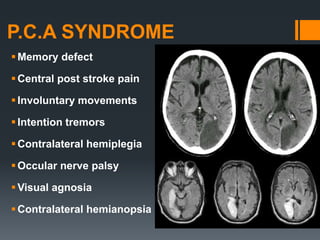P.C.A SYNDROME
Memory defect
Central post stroke pain
Involuntary movements
Intention tremors
Contralateral hemiplegia
Occular nerve palsy
Visual agnosia
Contralateral hemianopsia
 