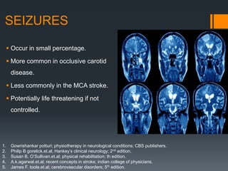 SEIZURES
 Occur in small percentage.
 More common in occlusive carotid
disease.
 Less commonly in the MCA stroke.
 Potentially life threatening if not
controlled.
1. Gowrishankar potturi; physiotherapy in neurological conditions; CBS publishers.
2. Philip B gorelick.et.al; Hankey’s clinical neurology; 2nd edition.
3. Susan B. O’Sullivan.et.al; physical rehabilitation; th edition.
4. A.k.agarwal.et.al; recent concepts in stroke; indian college of physicians.
5. James F. toole.et.al; cerebrovascular disorders; 5th edition.
 