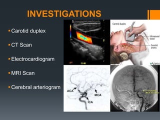 INVESTIGATIONS
Carotid duplex
CT Scan
Electrocardiogram
MRI Scan
Cerebral arteriogram
 