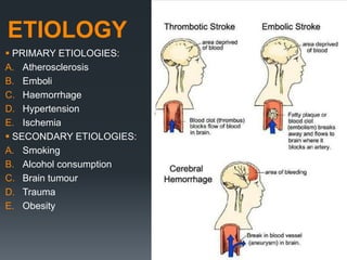 ETIOLOGY
 PRIMARY ETIOLOGIES:
A. Atherosclerosis
B. Emboli
C. Haemorrhage
D. Hypertension
E. Ischemia
 SECONDARY ETIOLOGIES:
A. Smoking
B. Alcohol consumption
C. Brain tumour
D. Trauma
E. Obesity
 