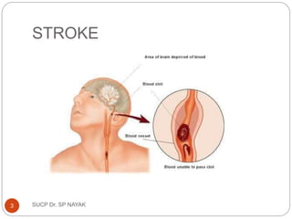 STROKE
SUCP Dr. SP NAYAK
3
 
