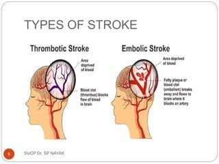TYPES OF STROKE
SUCP Dr. SP NAYAK
5
 
