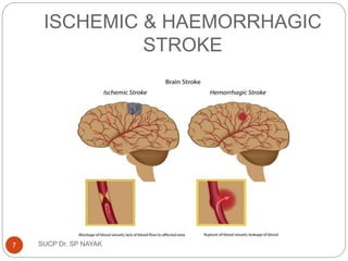 ISCHEMIC & HAEMORRHAGIC
STROKE
SUCP Dr. SP NAYAK
7
 