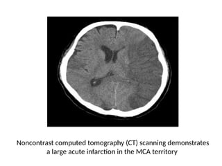 Noncontrast computed tomography (CT) scanning demonstrates
a large acute infarction in the MCA territory
 