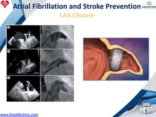 Atrial Fibrillation and Stroke Prevention
LAA Closure
www.theafibclinic.com
 