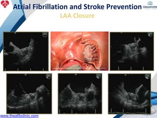 Atrial Fibrillation and Stroke Prevention
LAA Closure
www.theafibclinic.com
 