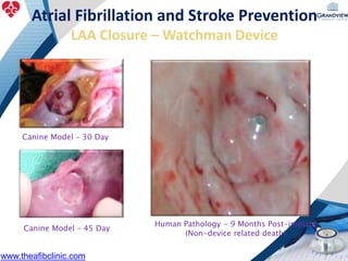 Atrial Fibrillation and Stroke Prevention
LAA Closure – Watchman Device
Canine Model – 30 Day
Canine Model – 45 Day
Human Pathology - 9 Months Post-implant
(Non-device related death)
www.theafibclinic.com
 
