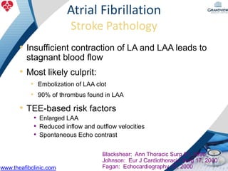 Atrial Fibrillation
Stroke Pathology
3000838-9
Blackshear: Ann Thoracic Surg 61, 1996
Johnson: Eur J Cardiothoracic Surg 17, 2000
Fagan: Echocardiography 17, 2000
• Insufficient contraction of LA and LAA leads to
stagnant blood flow
• Most likely culprit:
• Embolization of LAA clot
• 90% of thrombus found in LAA
• TEE-based risk factors
• Enlarged LAA
• Reduced inflow and outflow velocities
• Spontaneous Echo contrast
www.theafibclinic.com
 