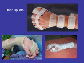 Hand splints
 