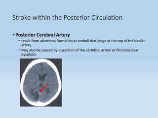 Stroke within the Posterior Circulation
• Posterior Cerebral Artery
• result from atheroma formation or emboli that lodge at the top of the basilar
artery
• May also be caused by dissection of the vertebral artery or fibromuscular
dysplasia
 