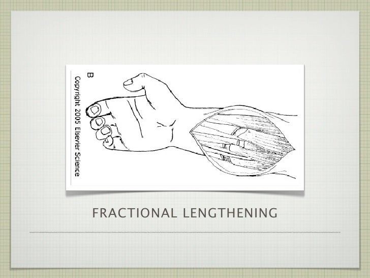 Spasticity in Stroke and Brain Injury Patients