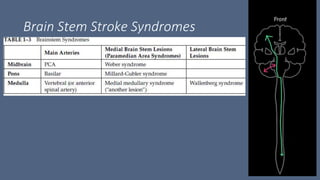 Brain Stem Stroke Syndromes
 