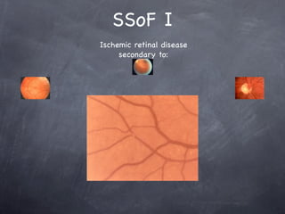 SSoF I
Ischemic retinal disease
     secondary to:
 