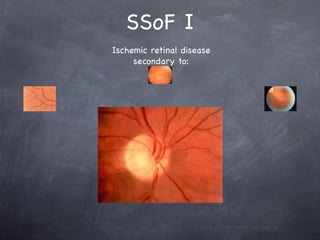 SSoF I
Ischemic retinal disease
     secondary to:
 