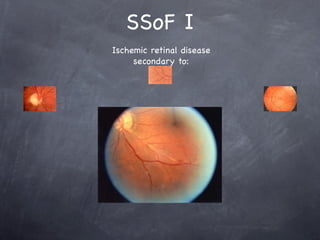 SSoF I
Ischemic retinal disease
     secondary to:
 
