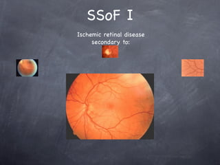 SSoF I
Ischemic retinal disease
     secondary to:
 