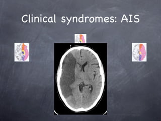 Clinical syndromes: AIS
 