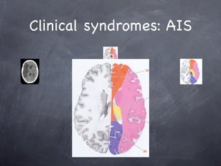 Clinical syndromes: AIS
 