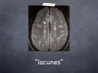 “lacunes”
 