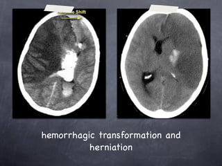 hemorrhagic transformation and
          herniation
 