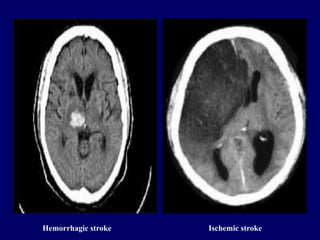 Hemorrhagic stroke Ischemic stroke
 