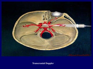 Transcranial Doppler
 