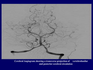 Cerebral Angiogram showing a transverse projection of vertebrobasilar
and posterior cerebral circulation
 