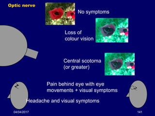 04/04/2017 141
Optic nerve
No symptoms
Loss of
colour vision
Central scotoma
(or greater)
Pain behind eye with eye
movements + visual symptoms
Headache and visual symptoms
 