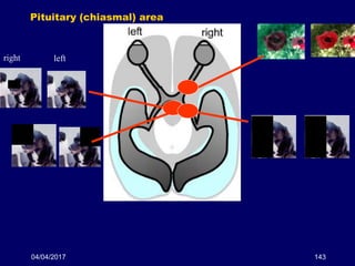 04/04/2017 143
Pituitary (chiasmal) area
right left
 