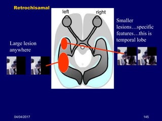 04/04/2017 145
Retrochisamal
Large lesion
anywhere
Smaller
lesions…specific
features…this is
temporal lobe
 