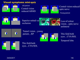 04/04/2017 146
Visual symptoms mini-quiz
Central vision
reduced ARMD
Superior retinal vein
occlusion
Tunnel vision…young
patient…RP
This field both
eyes…CVA/SOL
Loss of colour
vision…optic nerve
unilateral
This field both
eyes…CVA/SOL
Temporal lobe
Central vision reduced
optic nerve
Young patient
old patient
 