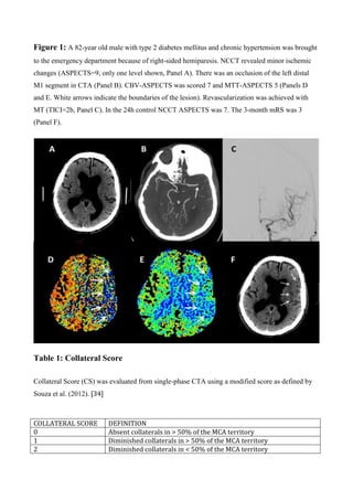 Figure 1: A 82-year old male with type 2 diabetes mellitus and chronic hypertension was brought
to the emergency department because of right-sided hemiparesis. NCCT revealed minor ischemic
changes (ASPECTS=9, only one level shown, Panel A). There was an occlusion of the left distal
M1 segment in CTA (Panel B). CBV-ASPECTS was scored 7 and MTT-ASPECTS 5 (Panels D
and E. White arrows indicate the boundaries of the lesion). Revascularization was achieved with
MT (TICI=2b, Panel C). In the 24h control NCCT ASPECTS was 7. The 3-month mRS was 3
(Panel F).
Table 1: Collateral Score
Collateral Score (CS) was evaluated from single-phase CTA using a modified score as defined by
Souza et al. (2012). [34]
COLLATERAL SCORE DEFINITION
0 Absent collaterals in > 50% of the MCA territory
1 Diminished collaterals in > 50% of the MCA territory
2 Diminished collaterals in < 50% of the MCA territory
 