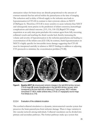 35
attenuation values for brain tissue are directly proportional to the amount of
contrast material that has arrived within the parenchyma at the time of imaging.
The reduction and/or delay of blood supply to the ischemic area leads to
hypoattenuation in CTA-SI in contrast to later cytotoxic edema on NECT
[118](Figure 6). Therefore, CTA-SI is more sensitive to acute ischemia than NECT
and subsequently more precise in the prediction of infarct extension, hemorrhagic
complications and clinical outcome. [115, 116, 118-121] Rapid CTA image
acquisition at an early time point precludes the contrast agent from fully traversing
collateral vessels and reaching the distal vascular bed, thereby increasing the
volume and severity of hypoattenuation in the ischemic parenchyma and leading to
overestimation of the infarct core [122-124]. In contrast, frank hypoattenuation on
NECT is highly specific for irreversible tissue damage suggesting that CTA-SI
must be interpreted carefully in relation to NECT findings in addition to adjusting
CTA protocols to minimize the overestimation problem [75-80].
Figure 6. Baseline NECT (A) showing early ischemic changes in the right MCA territory (arrows).
CTA-SI image (B) reveals hypoattenuation in the right MCA territory (arrows), which
corresponds to the final infarct (C) on follow-up CT scan (arrows). NECT indicates
noncontrast CT; MCA, middle cerebral artery; CTA-SI, CT angiography source image.
From Bhatia et al. [116]
2.2.2.4 Evaluation of the collateral circulation
The cerebral collateral circulation is a dynamic, interconnected vascular system that
preserves the brain parenchyma from ischemic damage. There is large variation in
this vascular network among individuals. Collateral vasculature can be divided into
primary and secondary pathways. The former pathways make up a system that
 