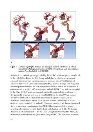46
A
Figure 8. A timeline depicting the strategies and techniques employed over the time to achieve
recanalization of a large vessel occlusionan ELVO in the setting of acute ischemic stroke.
Adapted, From Spiotta A.M. et al. [232, 233]
Stent retriever technology was preceded by the MERCI retriever system introduced
in the early 2000s (Figure 8). This device included most of the mechanisms of
action of stent retrievers, but the design was not stent-based. The Mechanical
Embolus Removal in Cerebral Ischemia (MERCI) trial was a single-arm study that
included patients between 3-8 h from symptom onset or within 3 h if there was a
contraindication to IVT or if the treatment had failed [234]. This trial was extended
in the Multi MERCI study, an international, multicenter study in which a newer
device (the L5 retriever) was used if available [235]. In the late 2000s, a second
device was approved, the Penumbra endovascular aspiration device. In the
Penumbra Pivotal Stroke Trial 81% of patients achieved recanalization of the
occluded vessel but only 25% had mRS≤2 at three months [236]. Penumbra caused
fewer hemorrhagic complications than MERCI but corresponded to worse
neurological outcome, possibly due to distal embolization [237]. The Mechanical
Retrieval and Recanalization of Stroke Clots Using Embolectomy (MR RESCUE)
trial compared thrombectomy (performed using MERCI or a Penumbra device) to
 