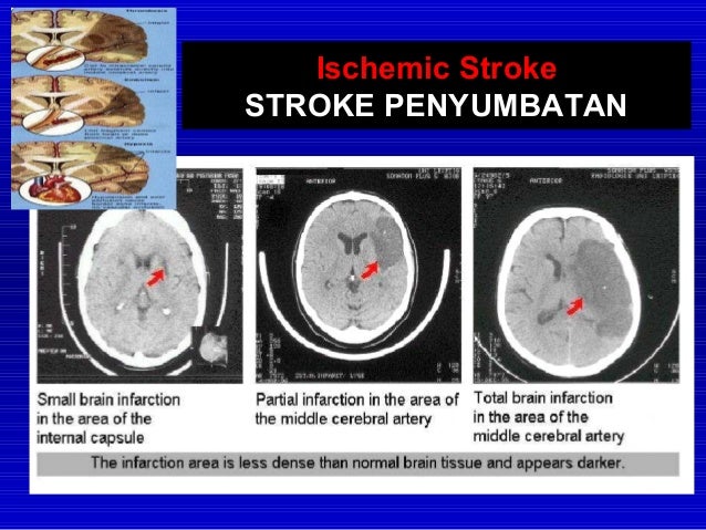 Stroke Basic Knowledge Bhs Indonesia