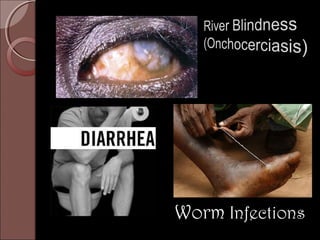 Worm Infections
 