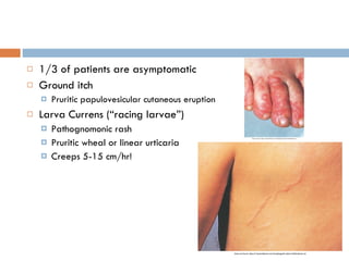 1/3 of patients are asymptomatic Ground itch Pruritic papulovesicular cutaneous eruption Larva Currens (“racing larvae”) Pathognomonic rash Pruritic wheal or linear urticaria Creeps 5-15 cm/hr! 