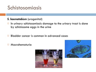 Schistosomiasis S. haematobium  (urogenital) In urinary schistosomiasis damage to the urinary tract is done by schistosome eggs in the urine Bladder cancer is common in advanced cases Macrohematuria 