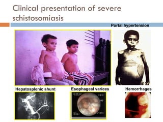 Clinical presentation of severe schistosomiasis Portal hypertension Hepatosplenic shunt Esophageal varices Hemorrhages 