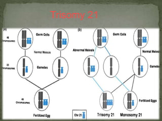 Trisomy 21
 